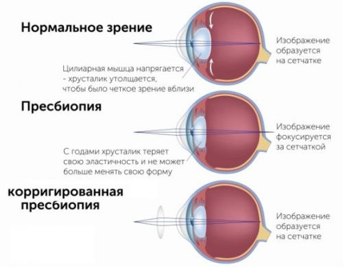 Старческая пресбиопия