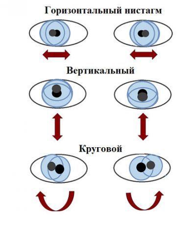 Нистагм Нистагм