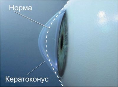 Кератоконус Кератоконус