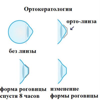 Ортокератология