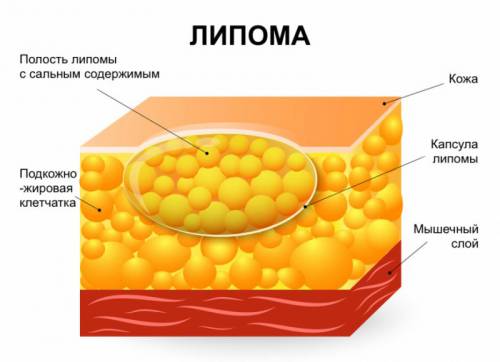 Образование жировика Образование жировика