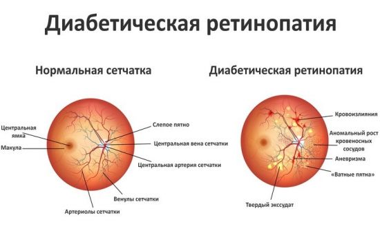 Диабетическая ретинопатия