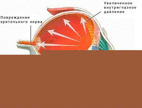 Суть глаукомы