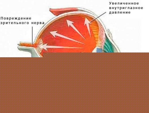Опасности глаукомы