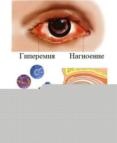 Конъюнктивит