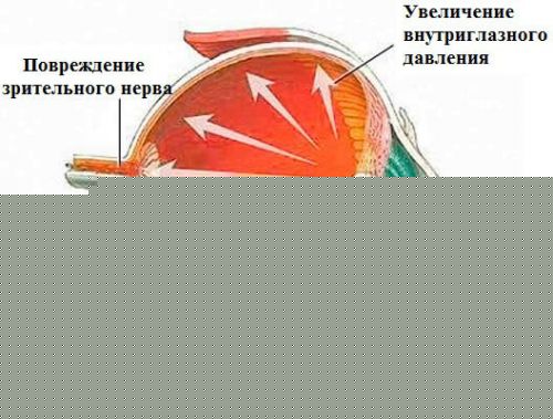 Повреждающие факторы при глаукоме