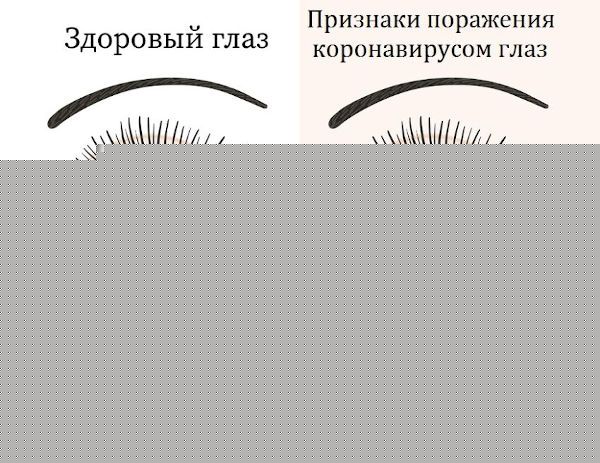 Глаз, пораженный коронавирусом