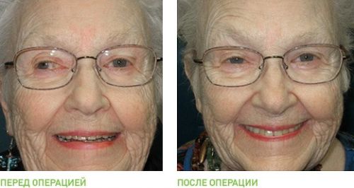 До и после операции при косоглазии
