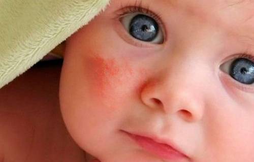 Сыпь на коже лица у ребенка Сыпь на коже лица у ребенка