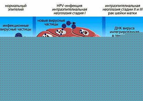 Развитие папилломы Развитие папилломы