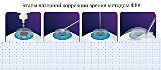 Проведение лазерной коррекции