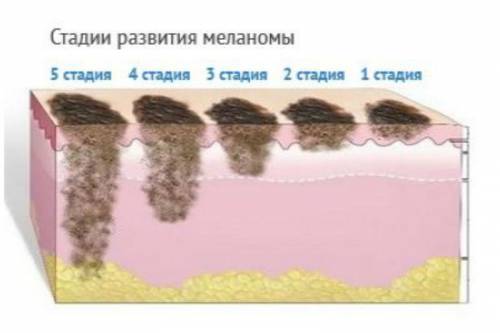 Стадии меланомы