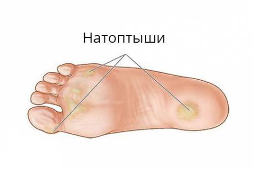 Места появления натоптышей