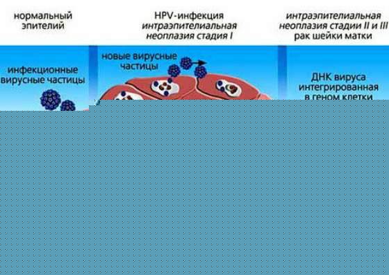 Стадии заражения ВПЧ Стадии заражения ВПЧ