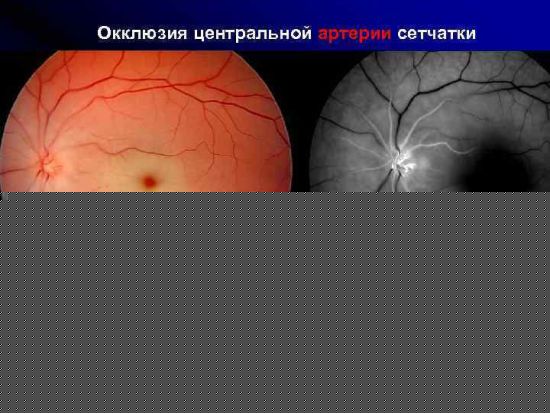 Окклюзия центральной артерии сетчатки