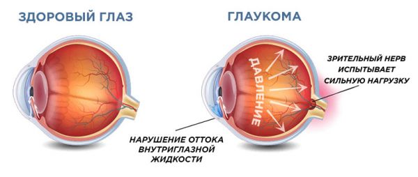 Глаукома