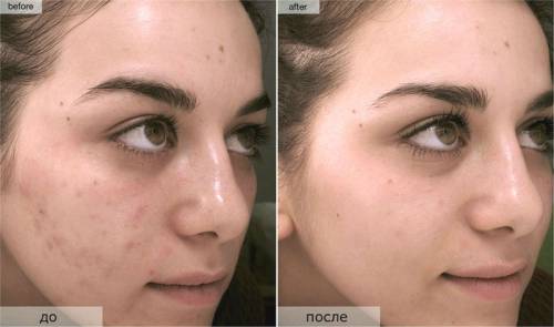 До и после лечения прыщей Роаккутаном До и после лечения прыщей Роаккутаном