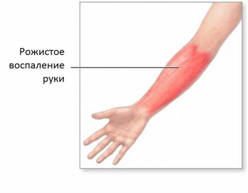 Рожистое воспаление Рожистое воспаление