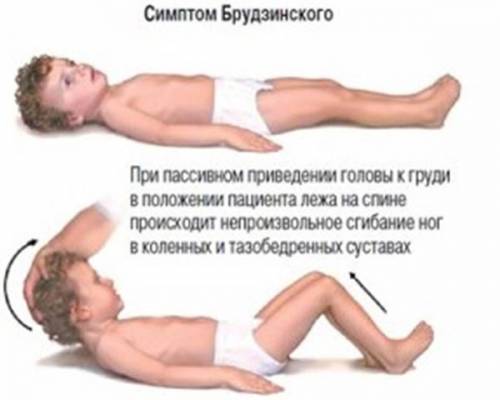 Симптом Брудзинского