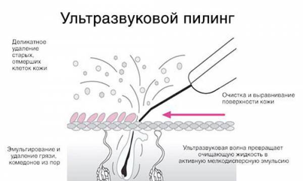 УЗ-пилинг