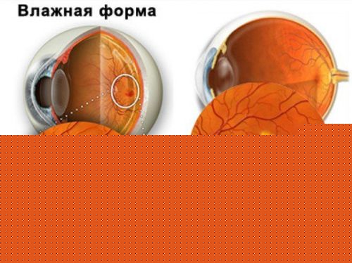 Формы возрасной макулярной дегенерации