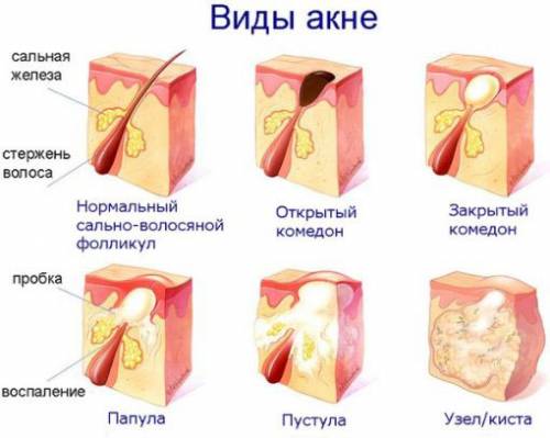 Виды прыщей