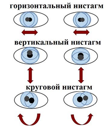 Нистагм