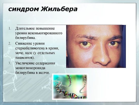Синдром Жильбера