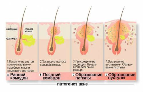 Образование акне Образование акне