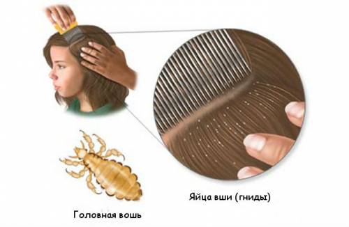 Педикулез Педикулез