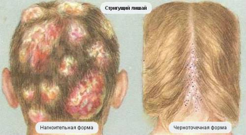Стригущий лишай Стригущий лишай